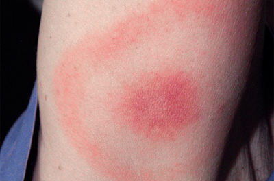A person's arm with a bullseye-shaped rash caused by Lyme disease